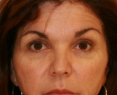 Feel Beautiful - Eyelid Surgery San Diego Case 46 - Before Photo